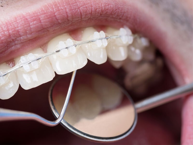 درمان نامرتبی دندان‌ها با ارتودنسی سرامیکی