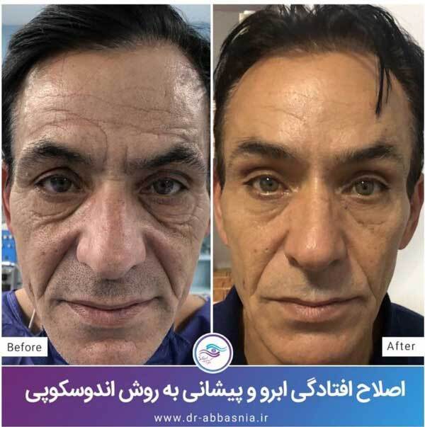 لیفت آندوسکوپی ابرو چیست؟