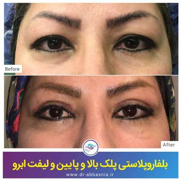 لیفت آندوسکوپی ابرو چیست؟