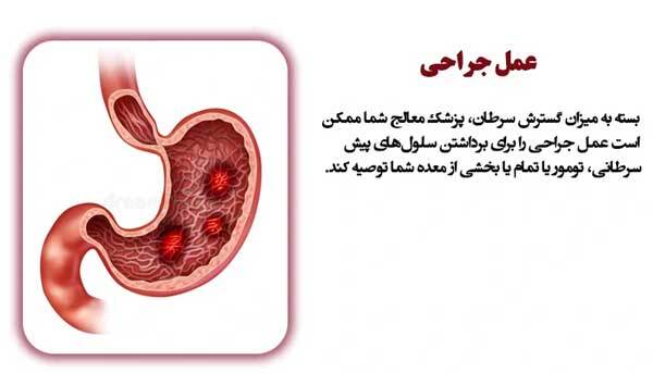 عمل جراحی سرطان معده