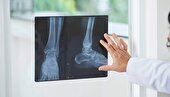 چگونه بعد از شکستگی مچ پا شروع به راه رفتن کنیم؟