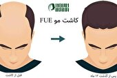 چه روشی برای کاشت مو در مشهد بهترین است؟