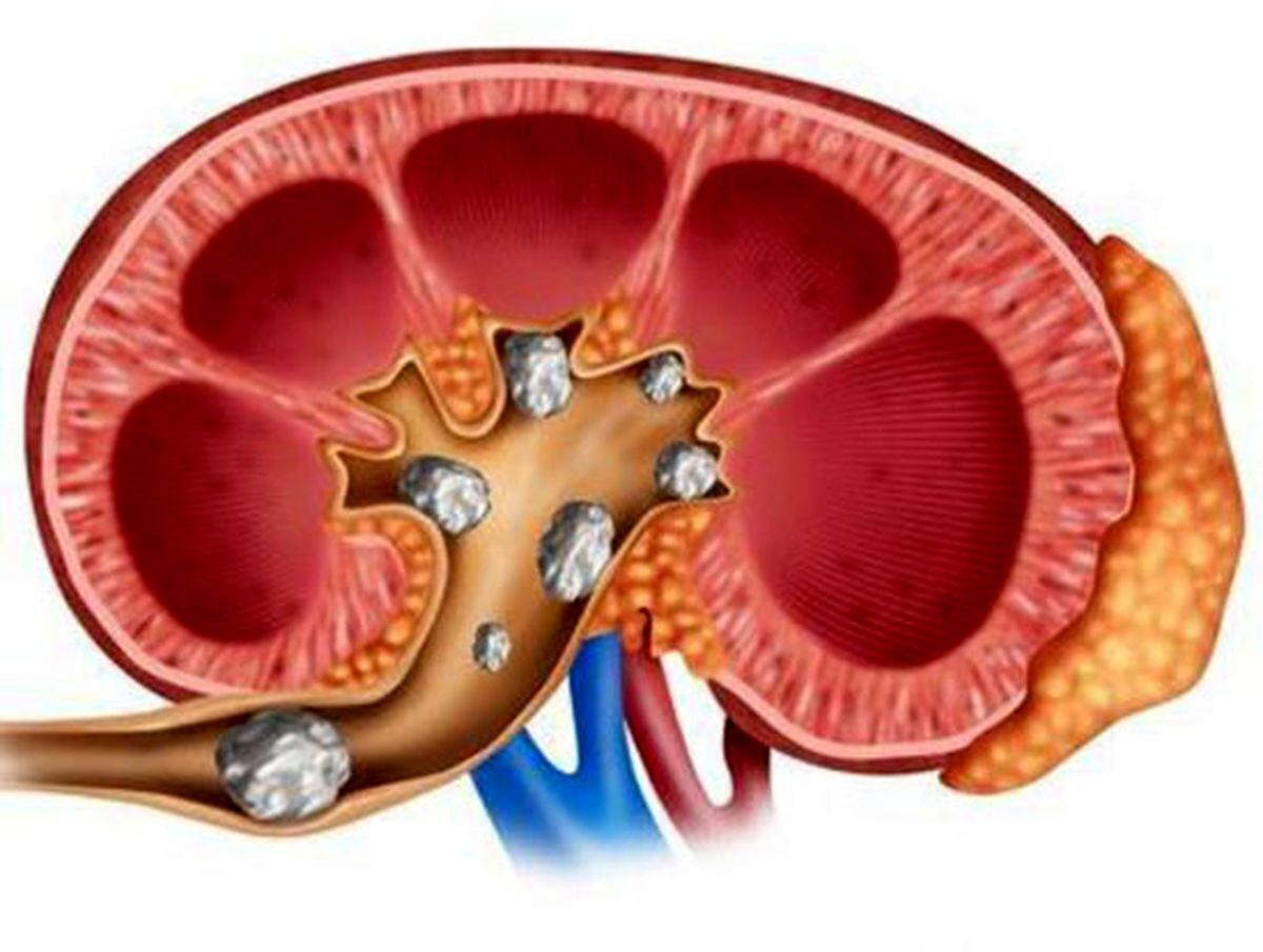 ببینید | تکنیک‌های خانگی دفع سنگ کلیه