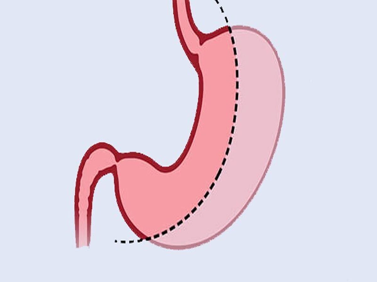 چاقی یکی از رایج ترین مشکلات سلامتی در دنیا است و بسیاری از افراد از جوامع مختلف درگیر این معضل هستند. البته راهکارهای مختلفی برای درمان این مشکل وجود دارد از رژیم غذایی گرفته تا عمل لاغری.