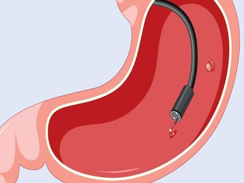 تفاوت عمل اسلیو معده و بوتاکس معده در چیست؟ تفاوت عمل اسلیو معده و بوتاکس معده در چیست؟