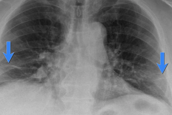 سریع ترین روش های درمان آب آوردن ریه در سالمندان