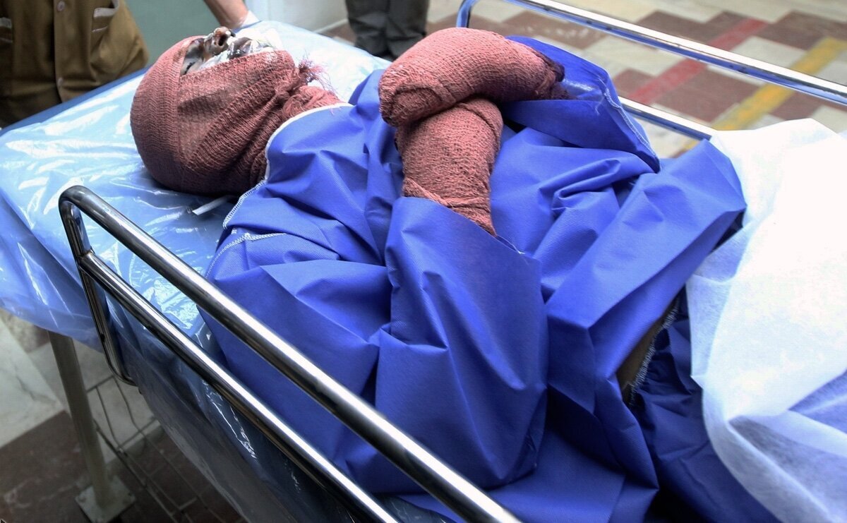 سوختگی در ایران ۸ برابر  متوسط جهانی است