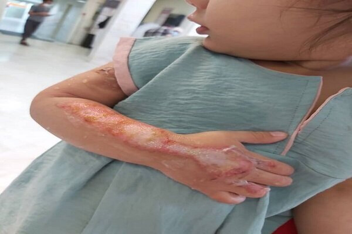 یک فلوشیپ فوق‌تخصصی جراحی ترمیمی و سوختگی با اشاره به فرارسیدن هفته پیشگیری از سوختگی هم‌زمان با آغاز فصل زمستان، بر لزوم توجه جدی به اصول ایمنی و آموزش همگانی در این زمینه تأکید کرد.