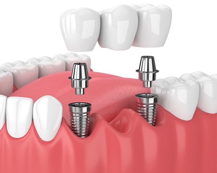 ایمپلنت دندانی با کمترین درد و بیشترین ماندگاری در مرکز تخصصی دکتر قادری ایمپلنت دندانی با کمترین درد و بیشترین ماندگاری در مرکز تخصصی دکتر قادری