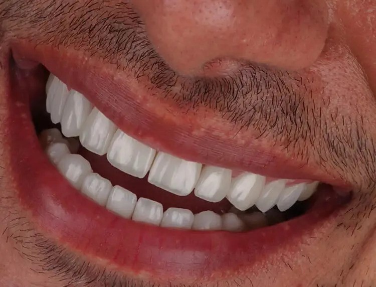 مقایسه لمینت و کامپوزیت دندان