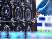 تشخیص بیماری آلزایمر با کمک هوش مصنوعی