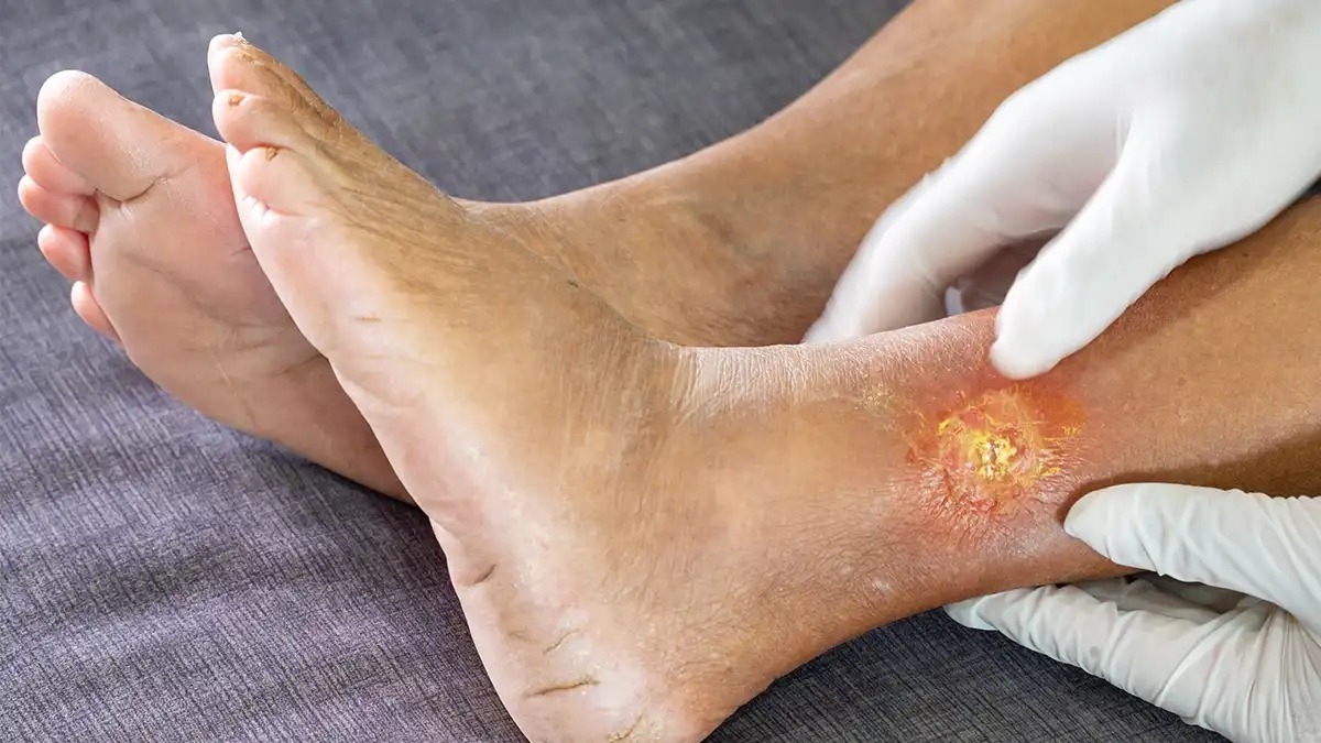 با افزایش شیوع دیابت در کشور، زخم پای دیابتی به یکی از عوارض جدی این بیماری تبدیل شده است. متخصصان به بیماران دیابتی توصیه می‌کنند که مراقبت‌های روزانه از پا و معاینات منظم برای پیشگیری از بروز این زخم‌ها را جدی بگیرند.