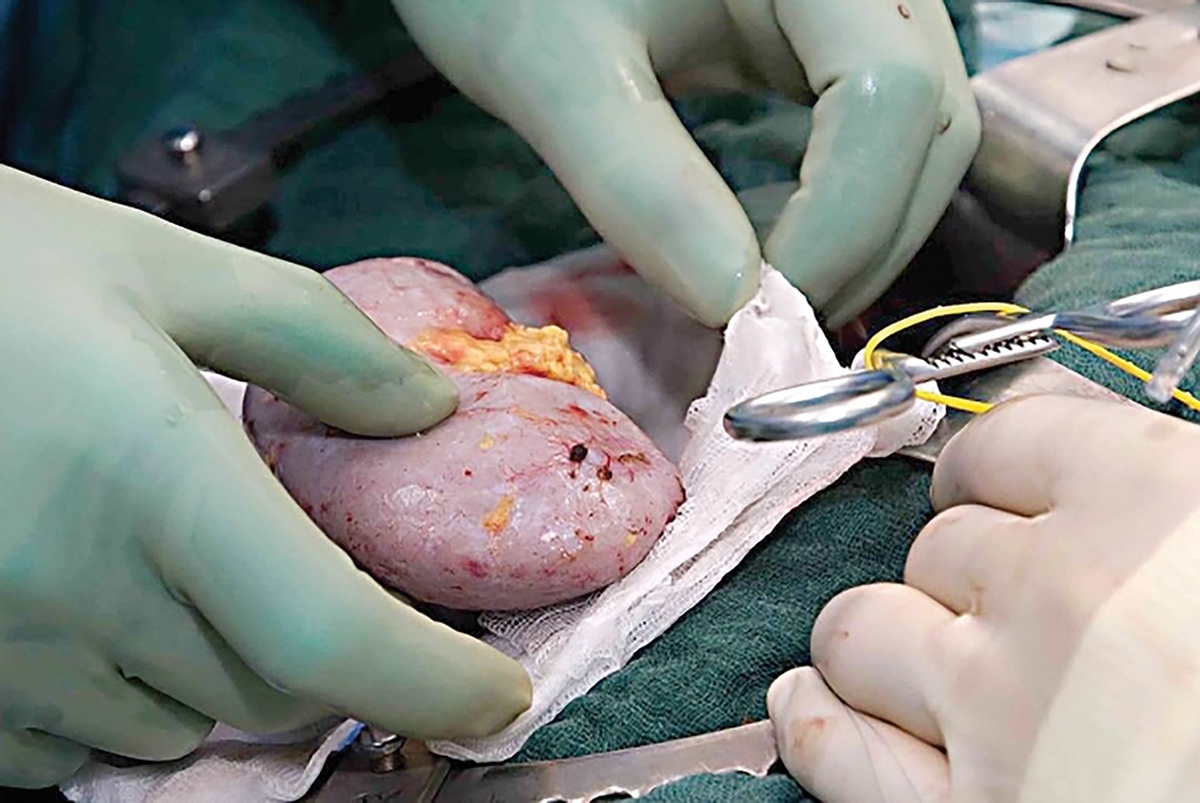 علل اصلی نارسایی کلیه در سطح جهانی و به‌ویژه در ایران، شامل دیابت و فشار خون بالاست که متأسفانه روند افزایشی دارد و به تبع آن، تعداد افراد نیازمند به درمان‌های جایگزین کلیه نیز سالانه افزایش می‌یابد. برای این بیماران، پیوند کلیه به عنوان درمان قطعی شناخته می‌شود.