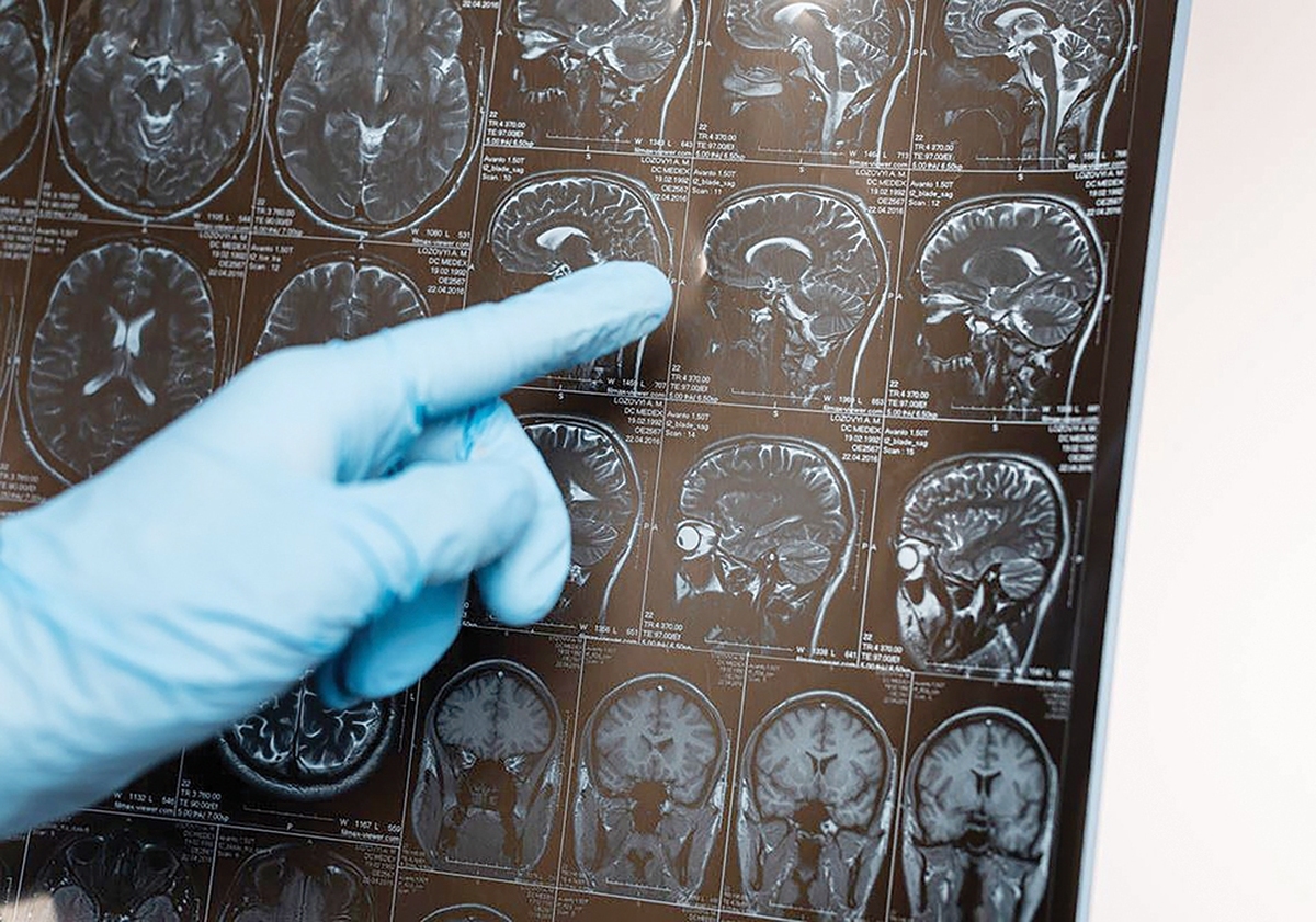 تحقیقات جدید نشان می‌دهد کودکانی که در دوران رشد، طلاق والدین را تجربه کرده‌اند، در سنین پیری با احتمال بسیار بیشتری دچار سکته مغزی می‌شوند. این ارتباط حتی در میان افرادی مشاهده شد که در کودکی قربانی آزار جسمی یا جنسی نبوده‌اند.