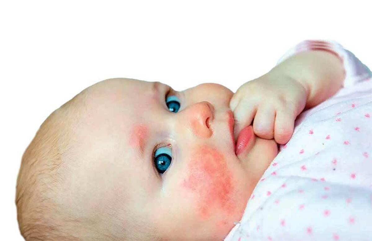 بسیاری انتظار دارند پوست نوزادان بی‌نقص باشد اما جوش‌ها یا التهابات پوستی و سایر عارضه‌های پوستی، در این سن بسیار رایج است.دربیشتر مواقع،این مشکلات با توجه دقیق به حمام کردن، مرطوب‌کننده‌ها و محیط زندگی نوزاد قابل مدیریت است.با این حال، برخی از این بثورات،ممکن است علی‌رغم مراقبت‌ها ظاهر شوند.