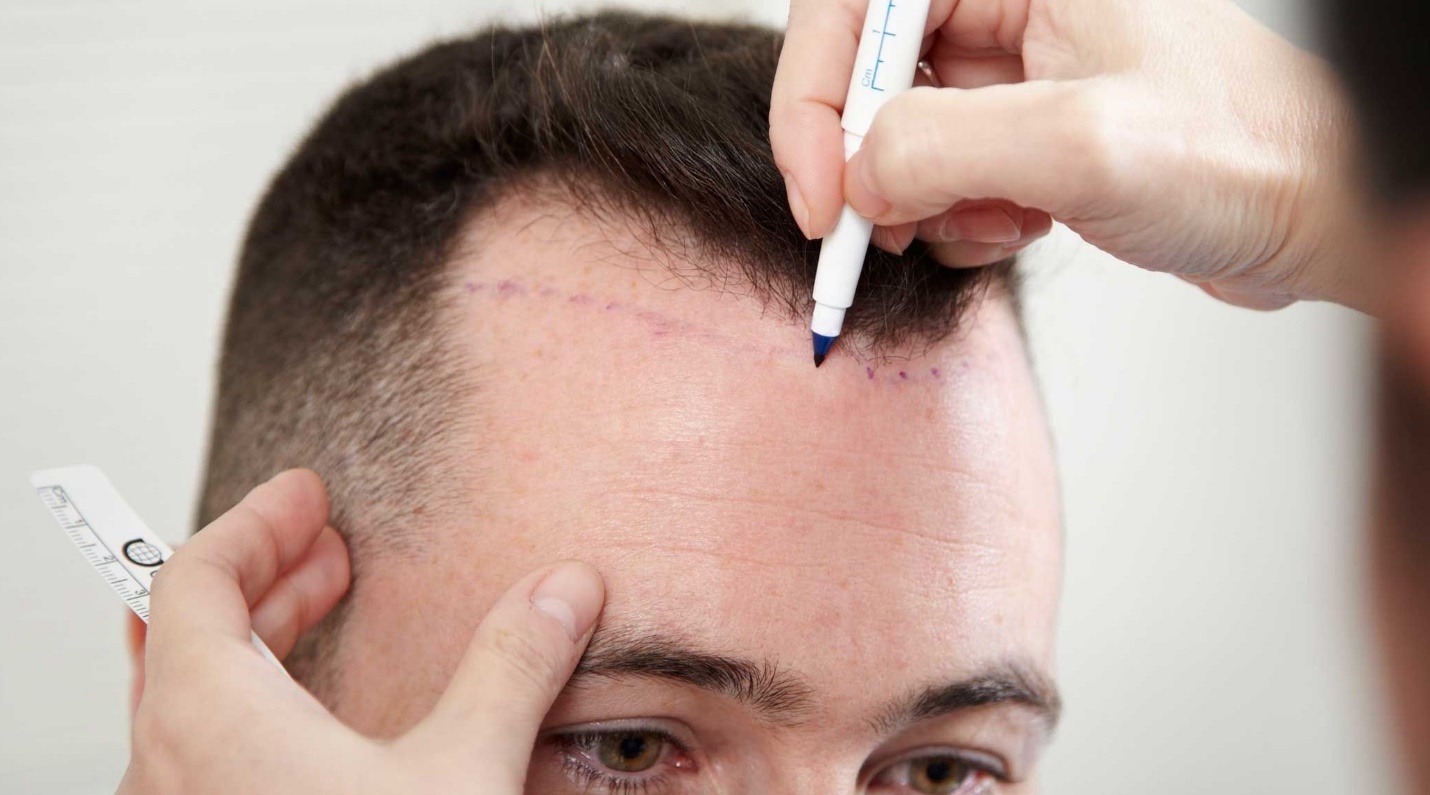 ویژگی های یک مرکز کاشت مو معتبر